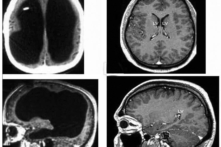 Is the Brain Really Necessary? The Answer Seems to be a No-Brainer